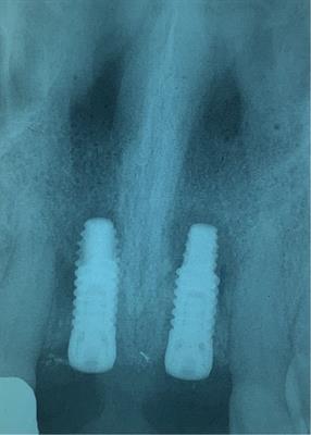 Case Report: One alternative surgical treatment of retrograde peri-implantitis